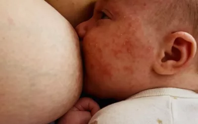 Troubles de la succion et allergie du bébé